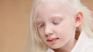 A young girl with albinism. 