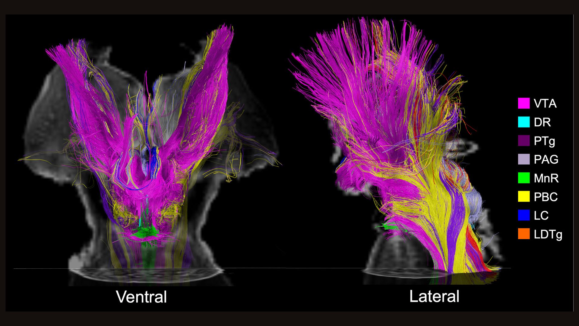Two side-by-side mri scans showing a human brain stem at two angles with colorful neuron tracts highlighted in various colors