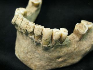 fossilized dental plaque