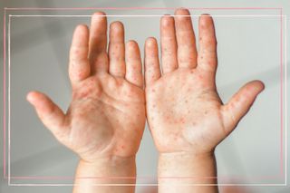 A pair of child's hands, palm up, showing what the hand, foot and mouth disease rash looks like.