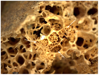 New Bone Formation in Lesion on Pelvis
