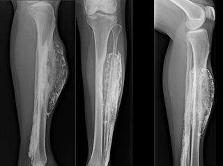 X-ray images show multiple views of patient's leg, revealing a calcified mass that developed following a snake bite.