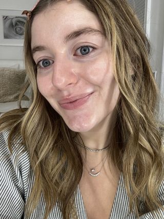 Samantha's skin after using Skinmedia AHA/BHA cleanser once per week