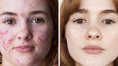 Accutane Results - Before and After
