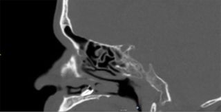 The CT scan of the man's nasal cavity showed a mass within.