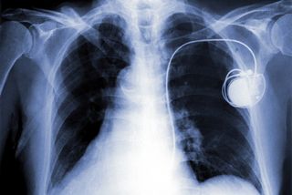 Pacemaker Chest X-Ray