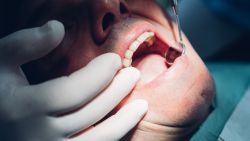 A close up of a man opening his mouth as two gloved hands hold it.