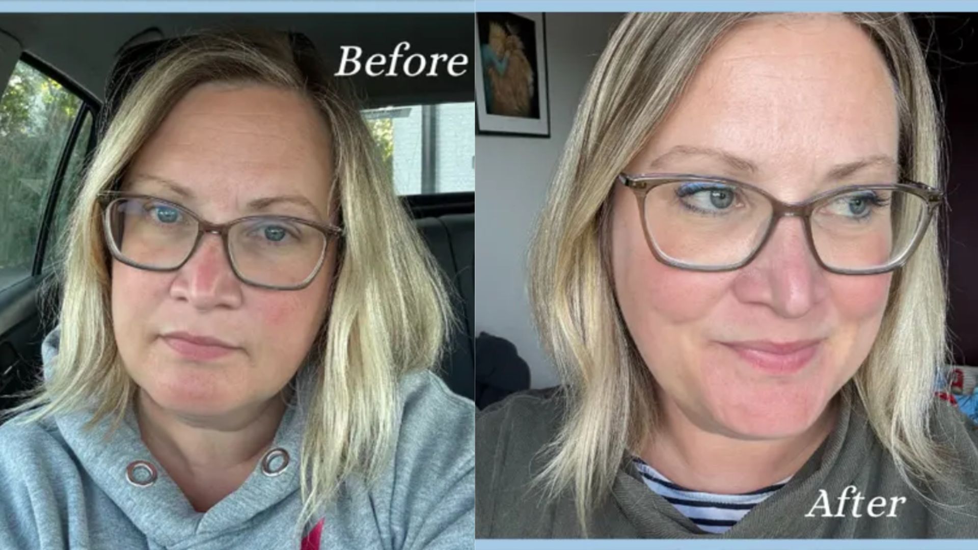Writer Heidi Scrimgeour pictured before and after using Kate Middleton's Botox in a Bottle
