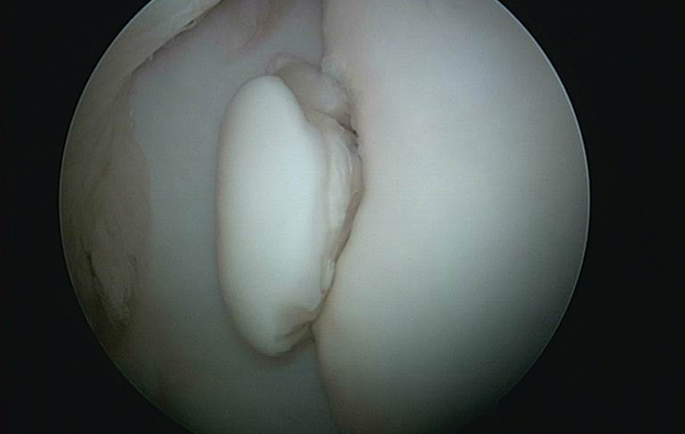 Arthroscopy reveals an OCD fragment in the hock. OCD chips are developmental and occur most frequently in the hock, stifle or fetlock