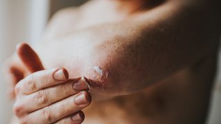 Man rubbing moisturizing lotion on dry elbows