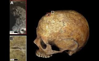 The mother's skull showed a small, circular wound, likely caused during primitive brain surgery called trepanation. A linear cut mark (bottom left) may show where her scalp was peeled back pre-surgery.