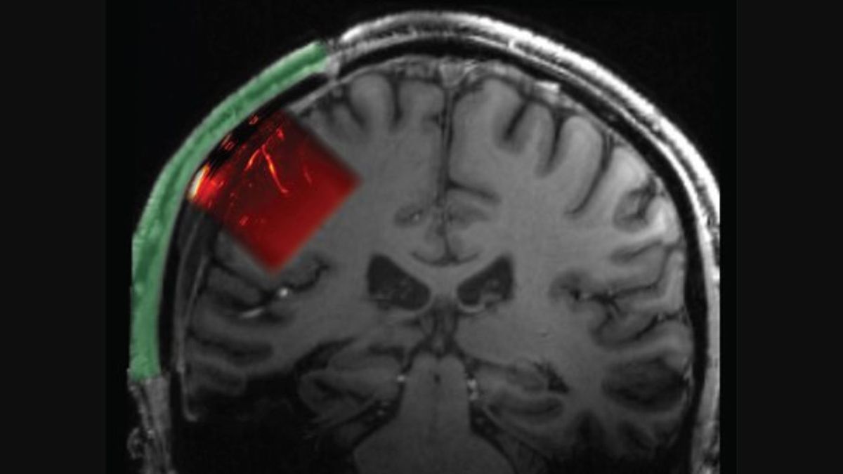 scan of a human brain with a section of the skull and tissue highlighted in red on the left side