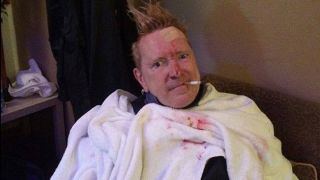 John Lydon after glass attack