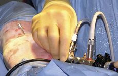 Arthoscopy