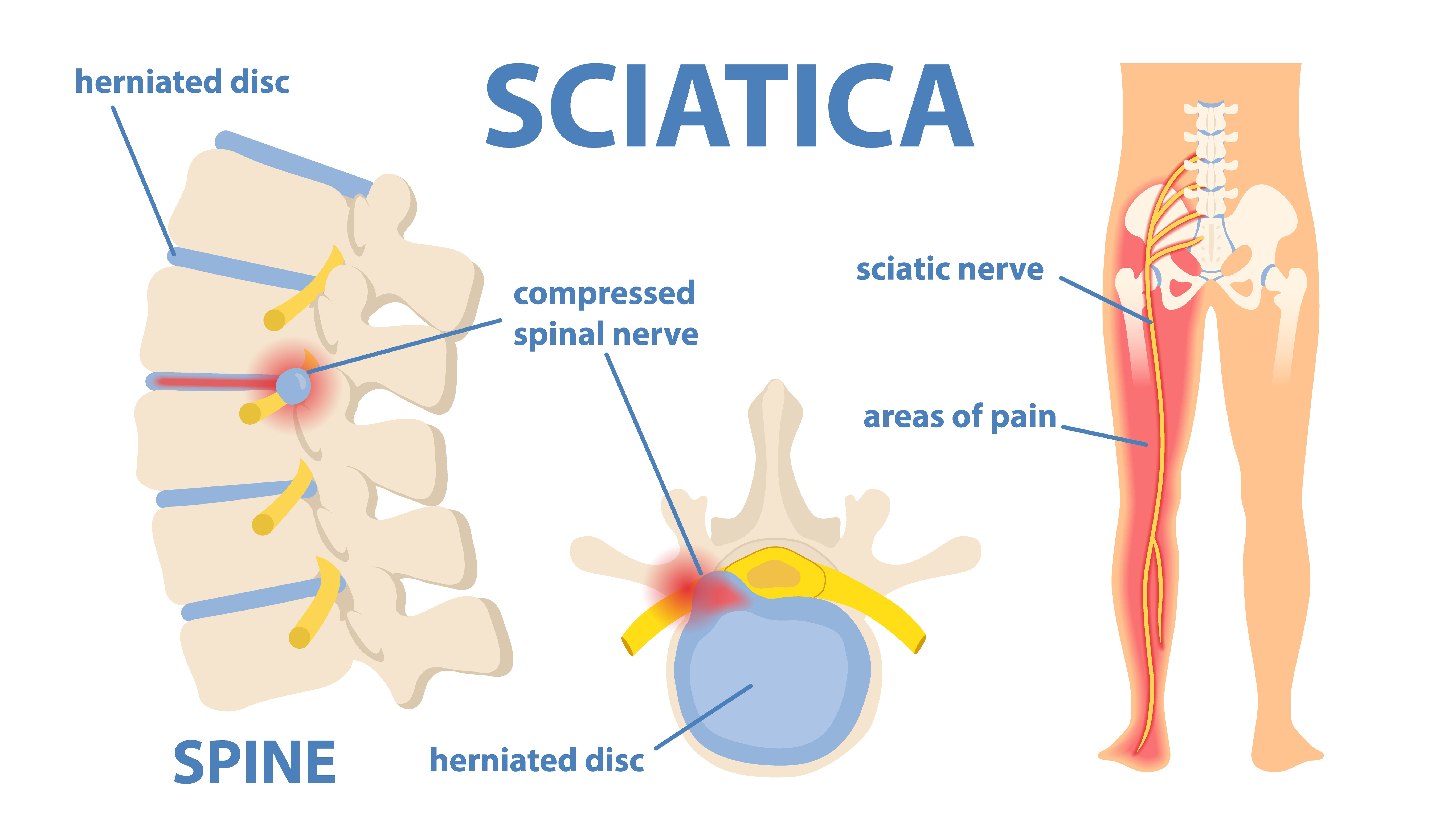 Sciatica infographic