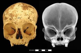 skull of abused toddler found in ancient egypt cemetery