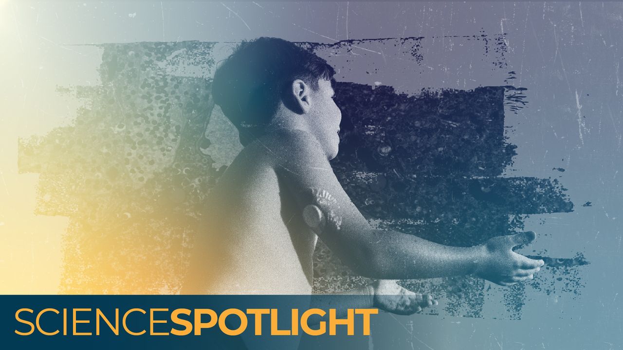 'A cure on the horizon': Are we finally close to ending type 1 diabetes?