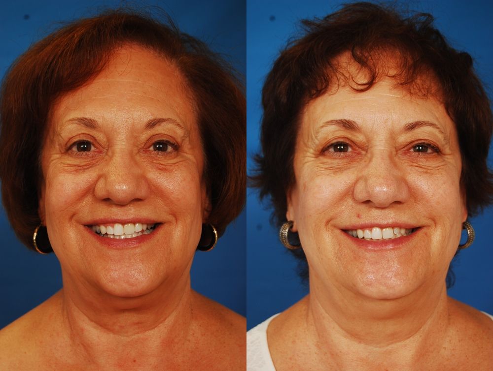 What to Look for in Cosmetic Surgery Before and After Photos