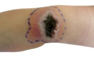 The image shows a necrotic ulcer on left wrist.