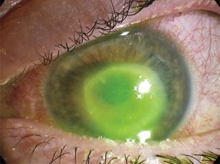 A woman in the United Kingdom was diagnosed with Acanthamoeba keratitis, a rare parasitic eye infection. She reported wearing contact lenses while swimming and showering, which is known to increase the risk of the condition. Above, an image of the woman's