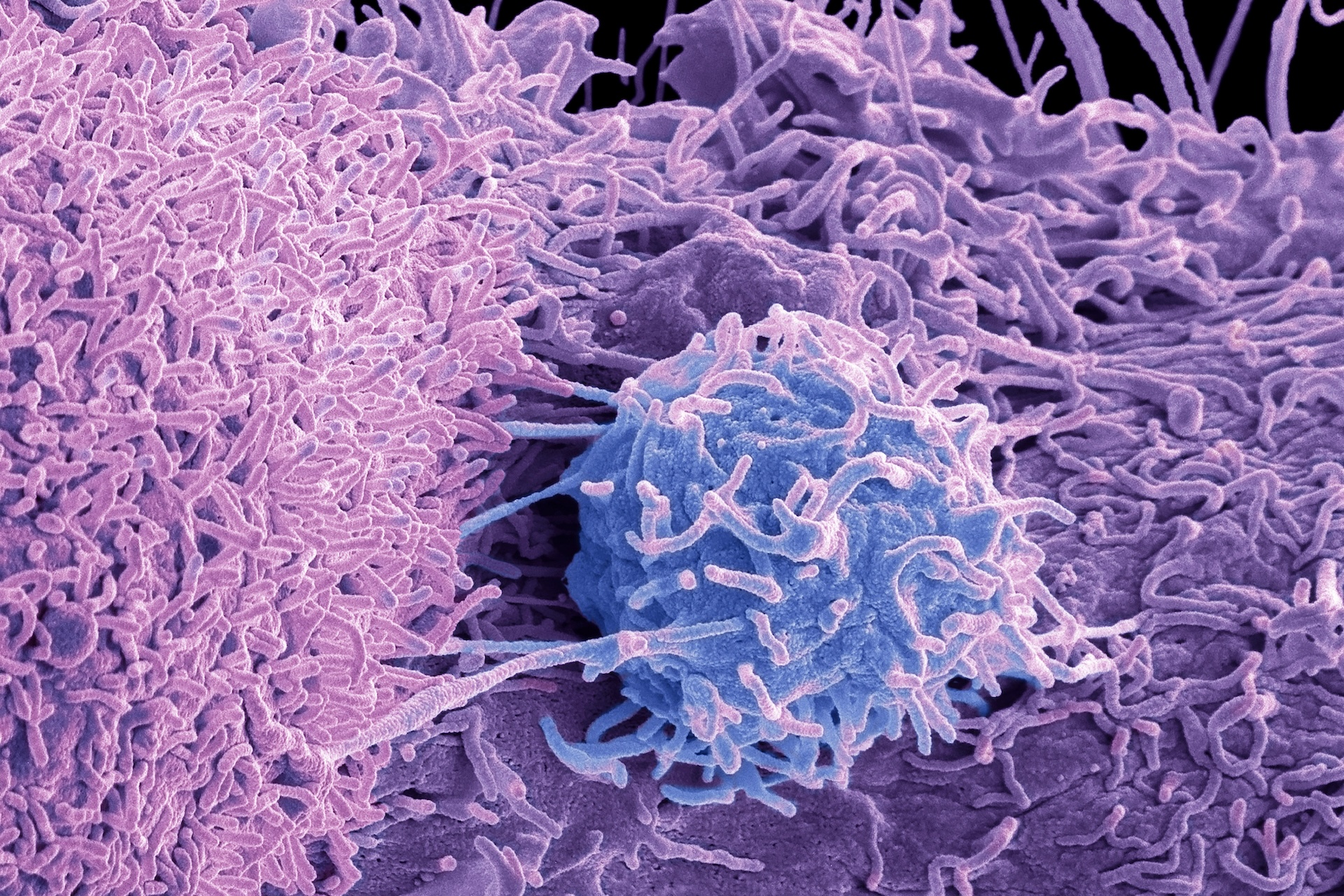 an electron microscope image of prostate cancer cells