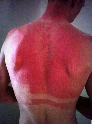 Chris Froome sunburn