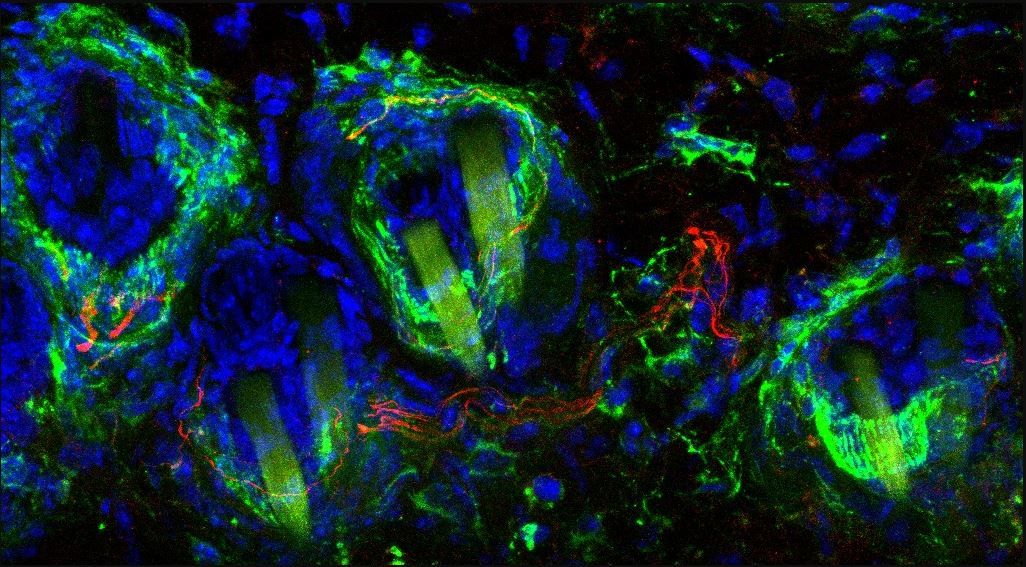 A light therapy provided pain relief to mice with neuropathic pain who had serve pain from even a gentle touch. Above, a microscopic image of the skin of a mouse, with the nerve cells that are responsible for sensitivity to gentle touch shown in green. Th