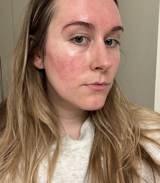 Kaitlyn McLintock with a rosacea flare-up