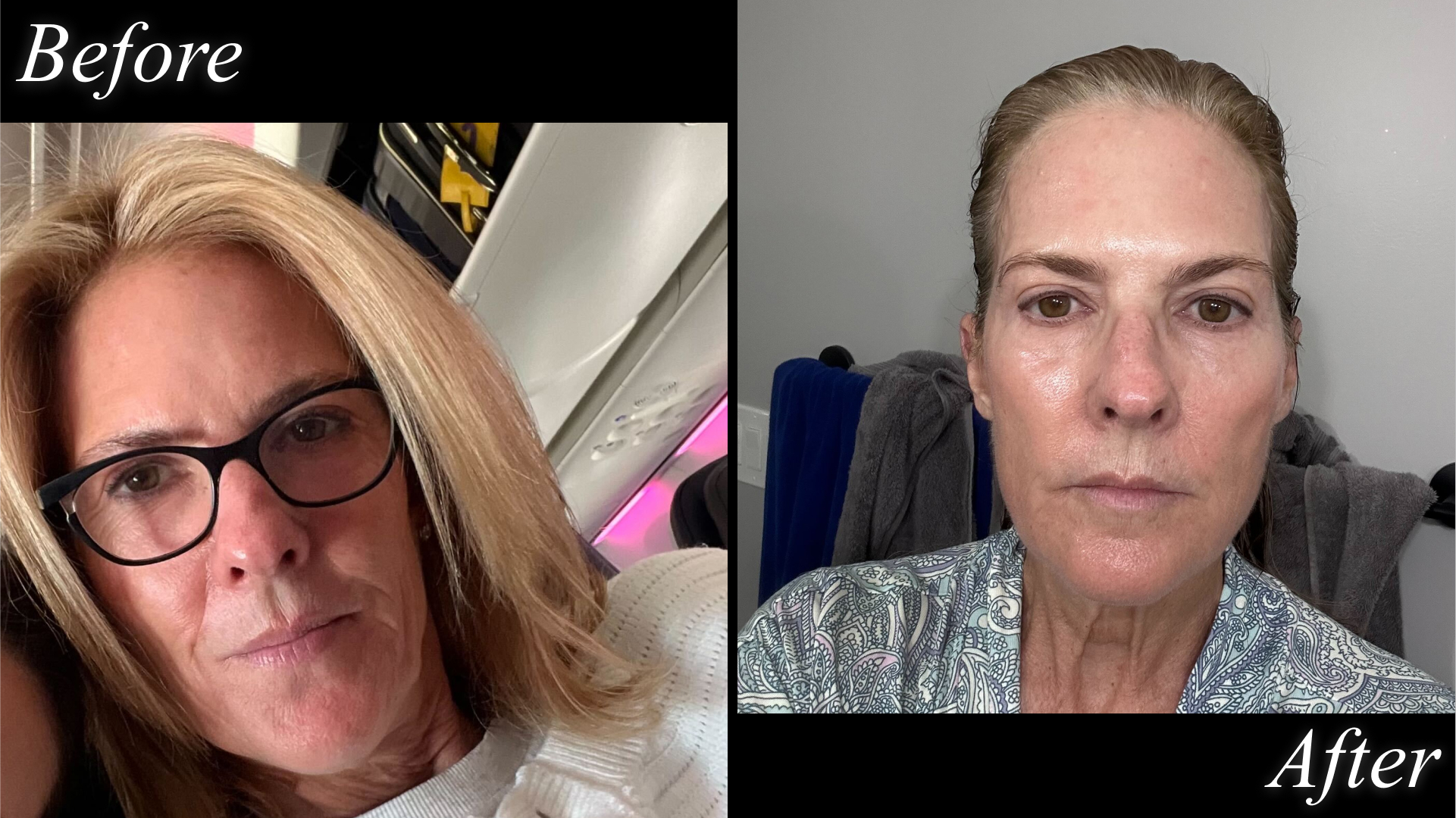 Testing Dennis Gross Universal Peel Pads before and after