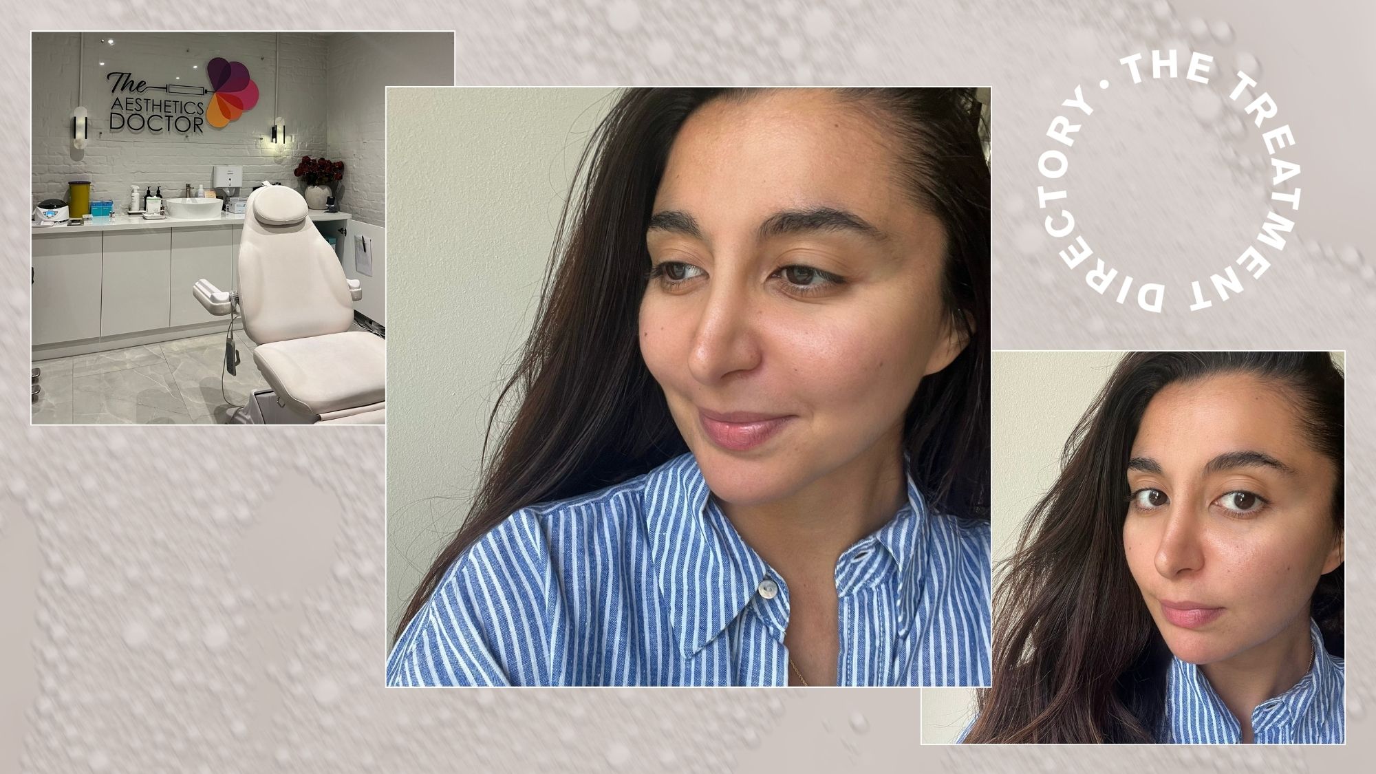 Senior shopping editor Marina Avraam having nasolabial filler