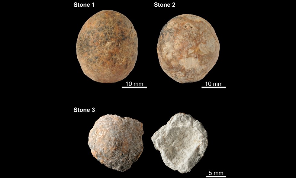 12,000-year-old prostate stones.