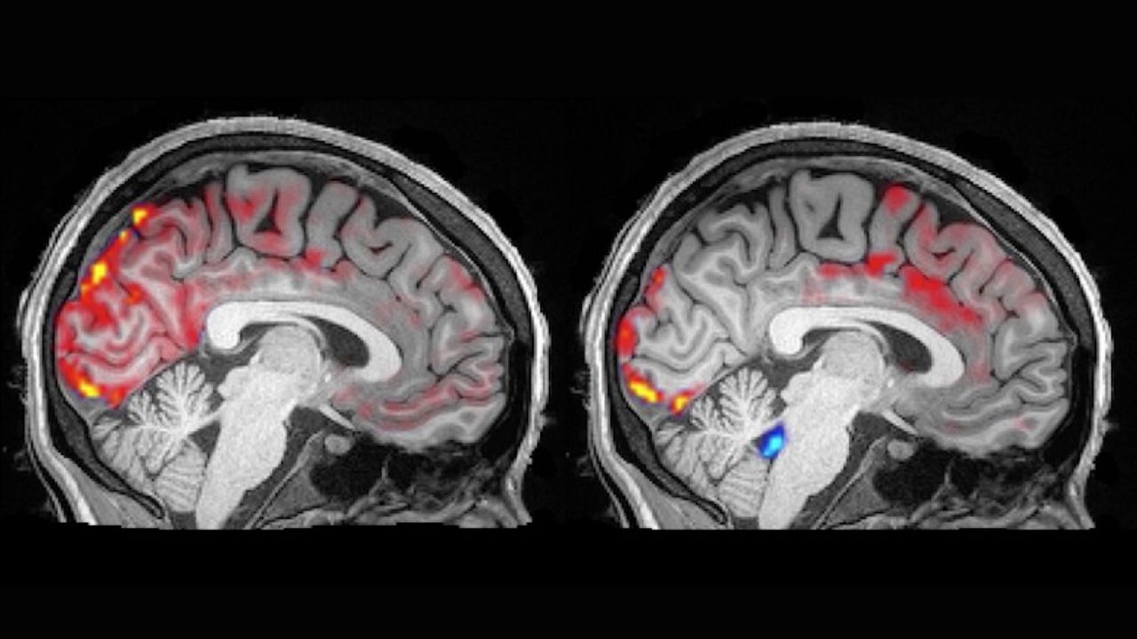 Two side-by-side black and white images showing a brain. The image on the left shows more red shading, while the image on the right shows less red shading but includes a small area near the brainstem that is highlighted with blue.