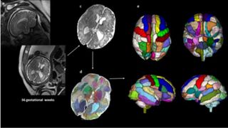 Images depicting the process the researchers used to analyze prenatal brain scans. (a-b) In-utero MRI images used in the study, (c) an MRI image after processing to mask the brain from the external tissue, (d) automatic segmentation of the brain structures, and (e) analysis of the segmented structures. 