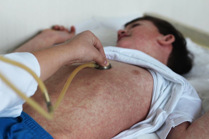 Young child with measles having his heart checked by a doctor