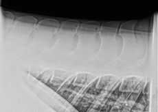 Kissing spines shown on x-ray