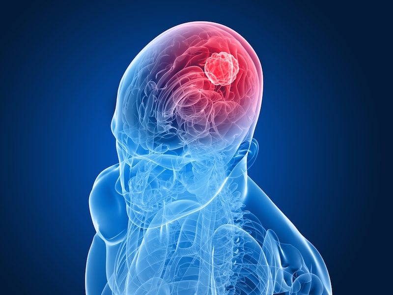 Brain Tumor Symptoms In Women