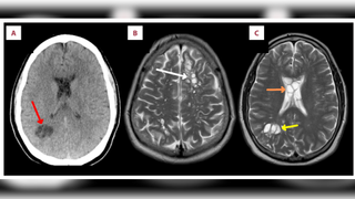Three brain scan images depicted side by side and labelled a to c. Lesions containing the parasite Taenia solium are highlighted by arrows in white, red, orange and yellow