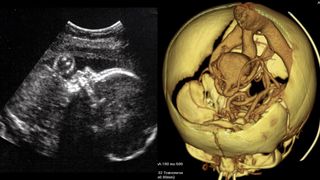 Two images shown side by side. Left image shows an ultrasound of a healthy baby in-utero. Right image shows a 3D diagram of blood vessels in a human baby's brain, showing a malformation known as the a "vein of Galen malformation"