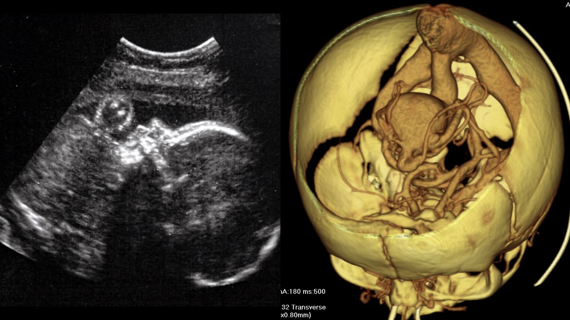 Two images shown side by side. Left image shows an Ultrasound of a healthy baby in-utero. Right image shows a 3D diagram of blood vessels in a human baby's brain, showing a malformation known as the a "vein of Galen malformation'
