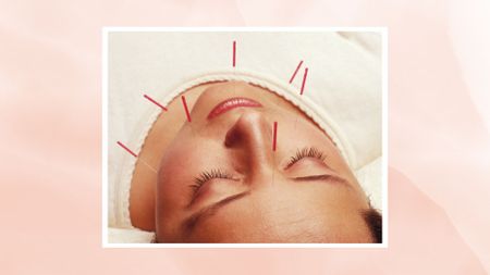 woman having facial acupuncture