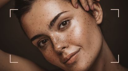 A woman after an at home chemical peel with smooth, glowing freckly skin