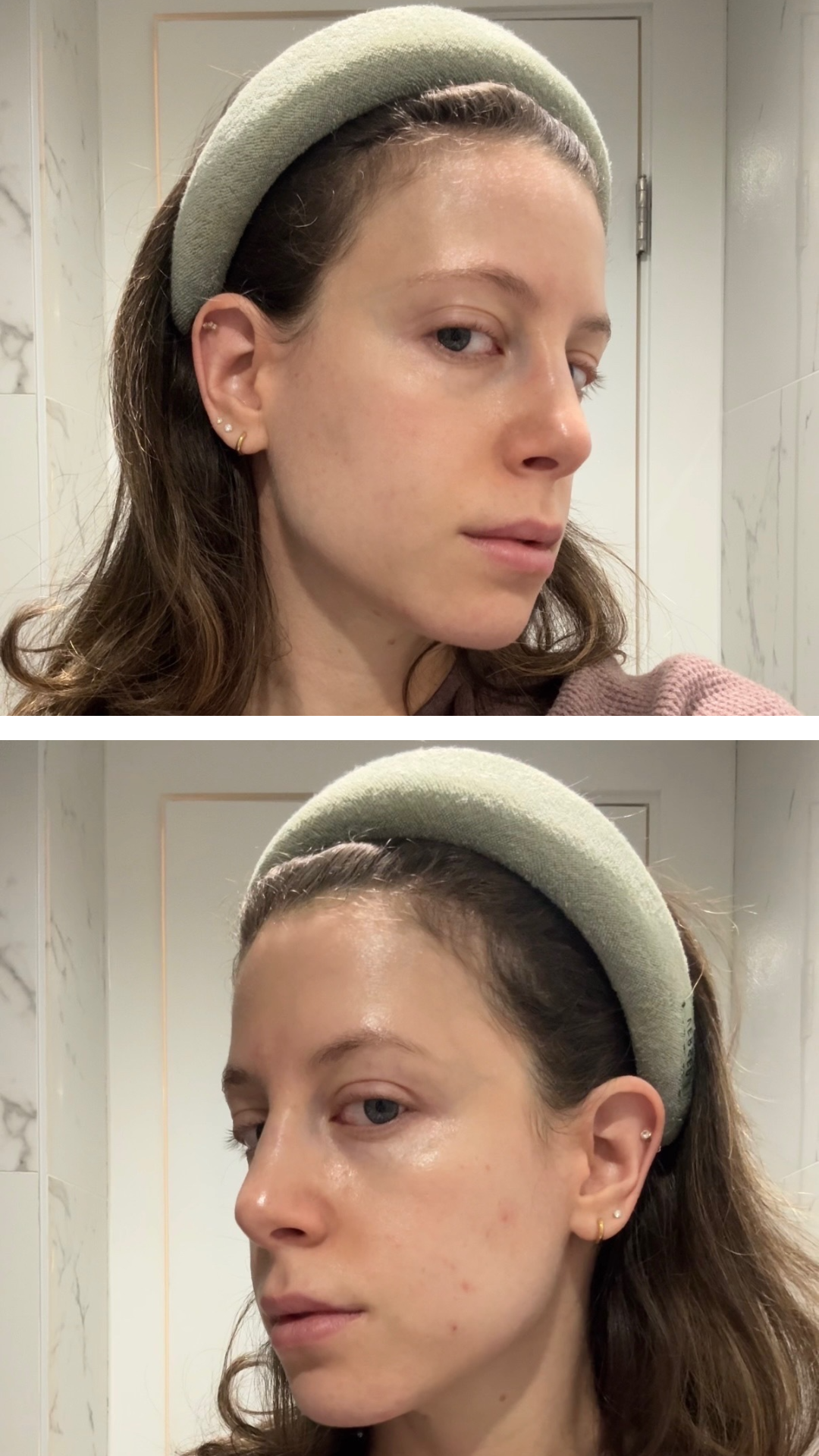 Jamie Schneider before and after using the Medicube Booster Pro