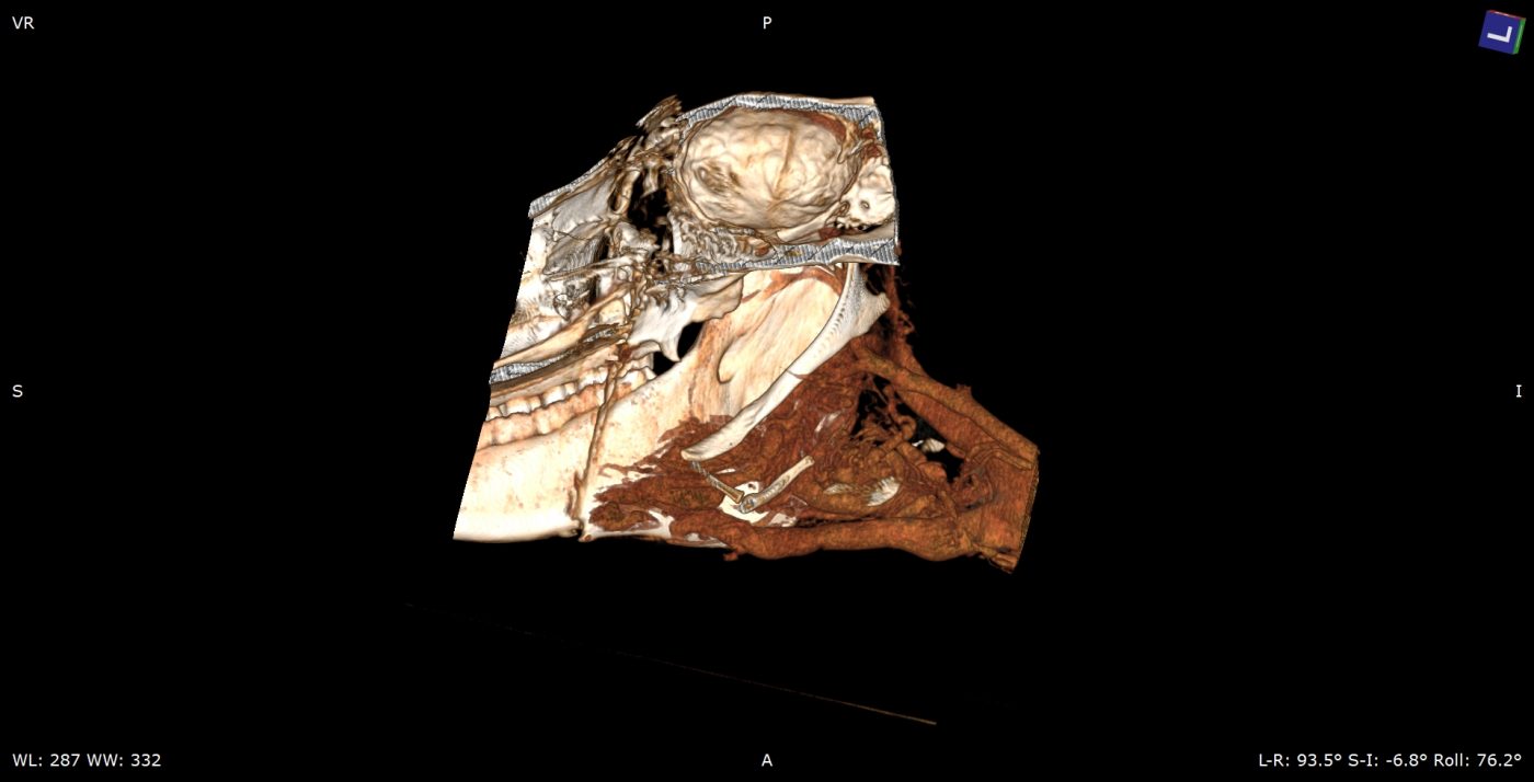 Reconstruction image showing the unusual blood vessels in brown.