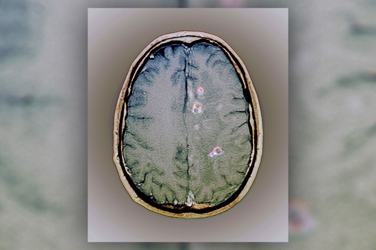 This Parasite Is a Surprising Cause of Seizures in the US