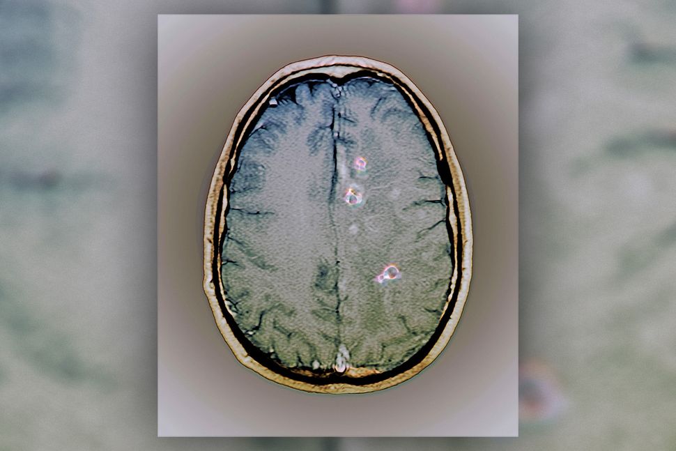 This Parasite Is a Surprising Cause of Seizures in the US Live Science