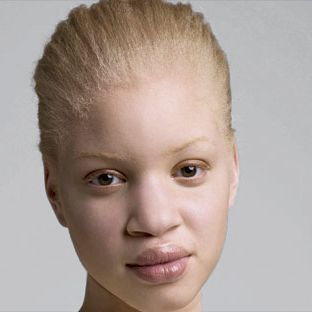 albino african