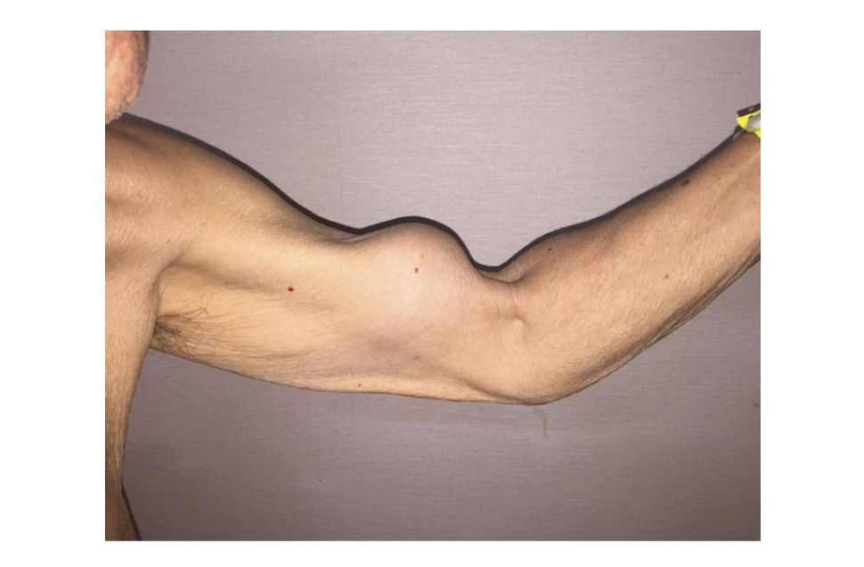 Here's Why a Man's Arm Looks Like Popeye's | Live Science