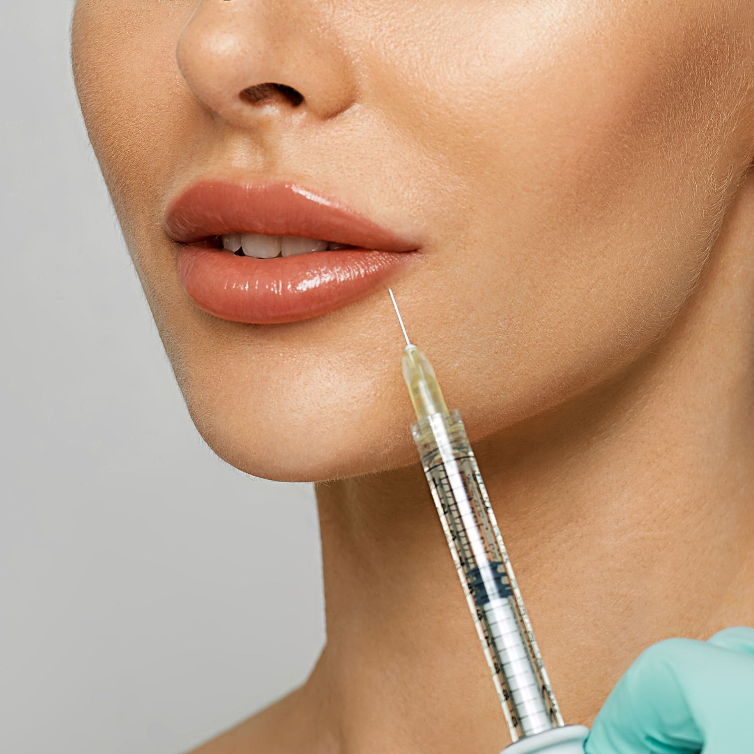 Everything you need to know about lip filler migration, as told by the experts