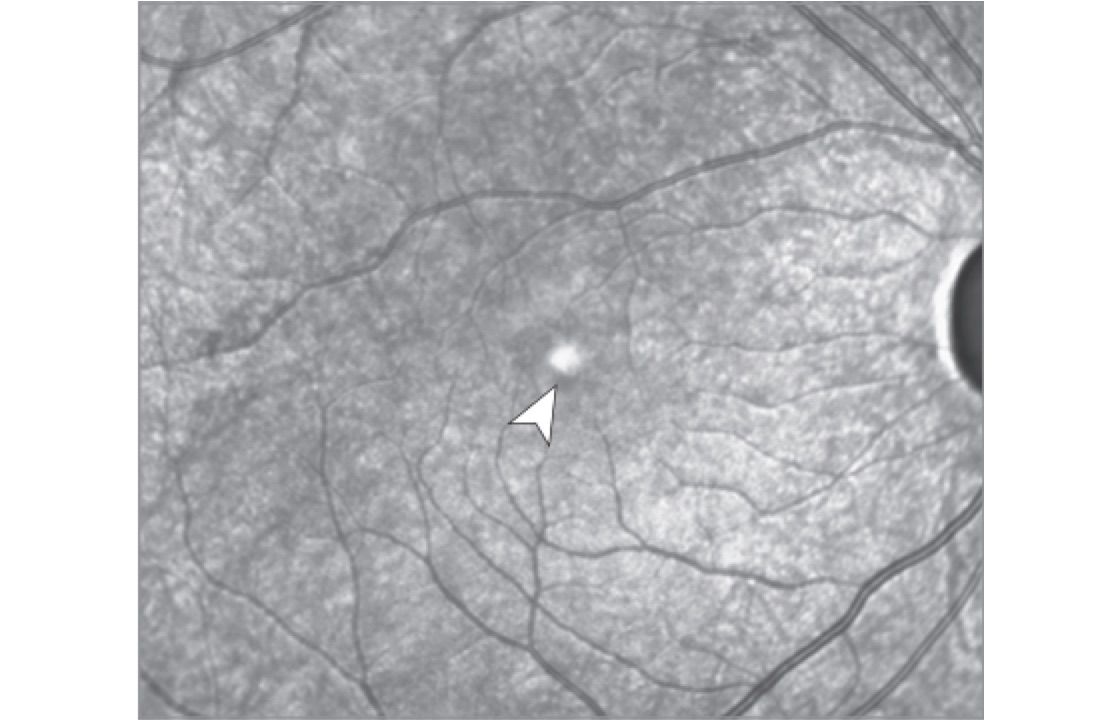 solar retinopathy, retina