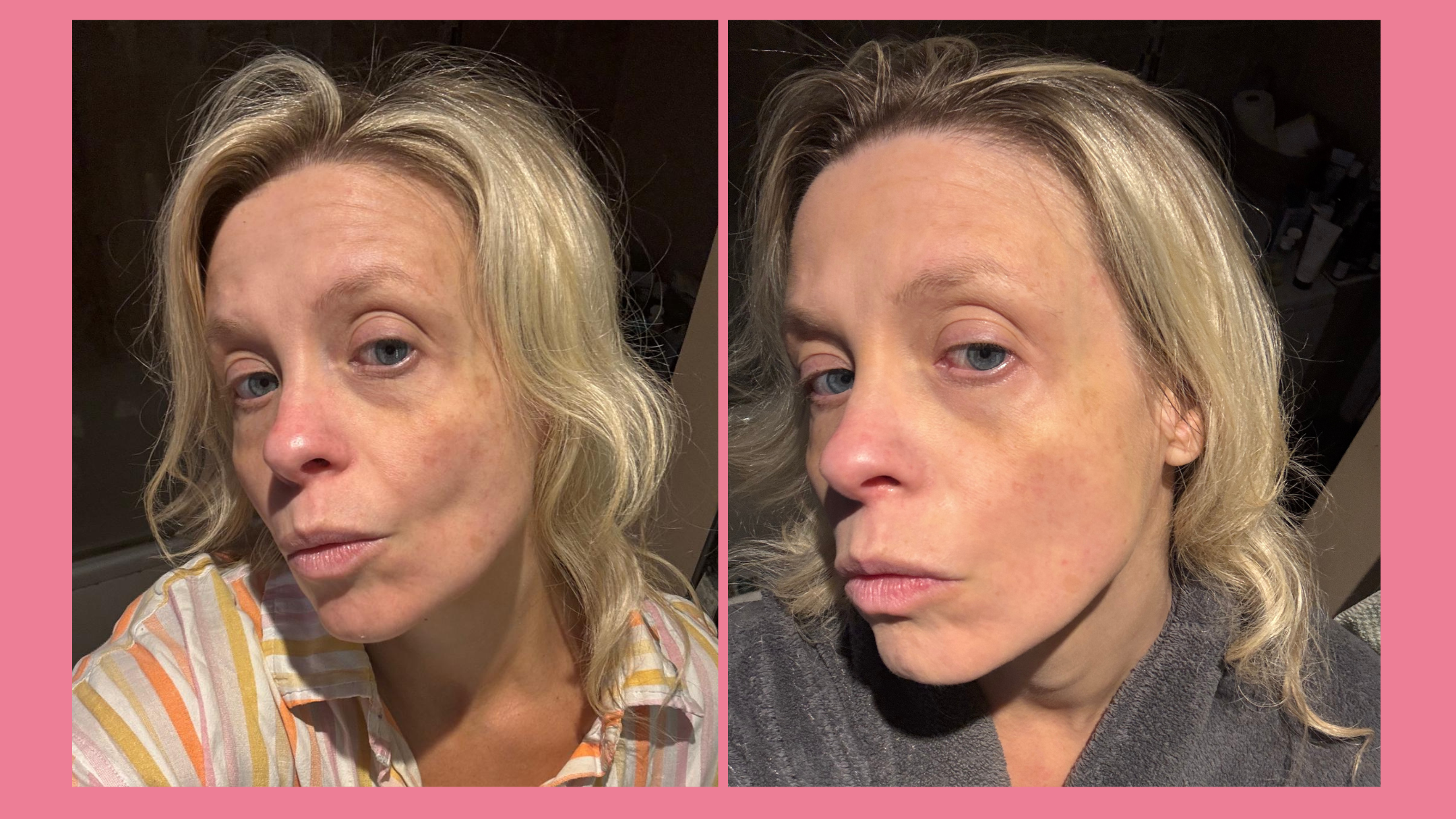 Before and after images of Tester Network member Jenny Church taken while testing Anua Niacinamide 10% + TXA 4% Serum for this review